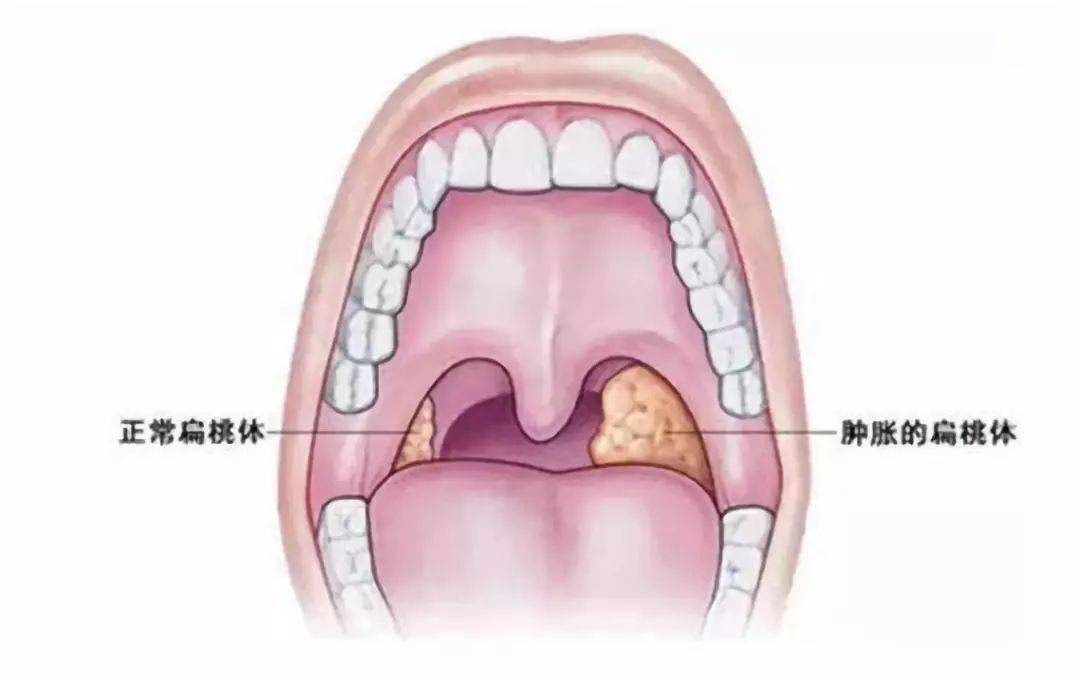 澳门知识专家解析，关于扁桃体发炎持续半个月的现象