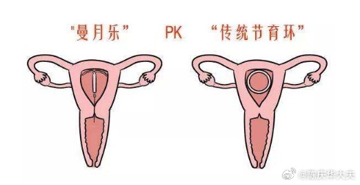 澳门知识专家解读，取环后第一个月月经量增多的现象